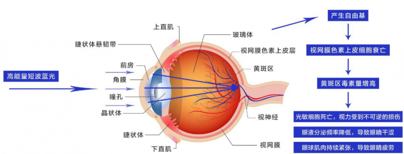 蓝光导致眼部问题眼部疾病